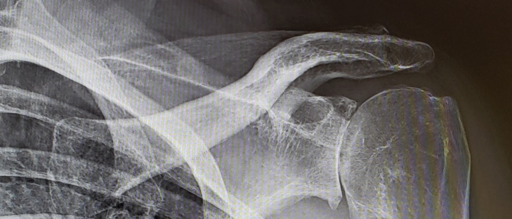 LG shoulder x-ray